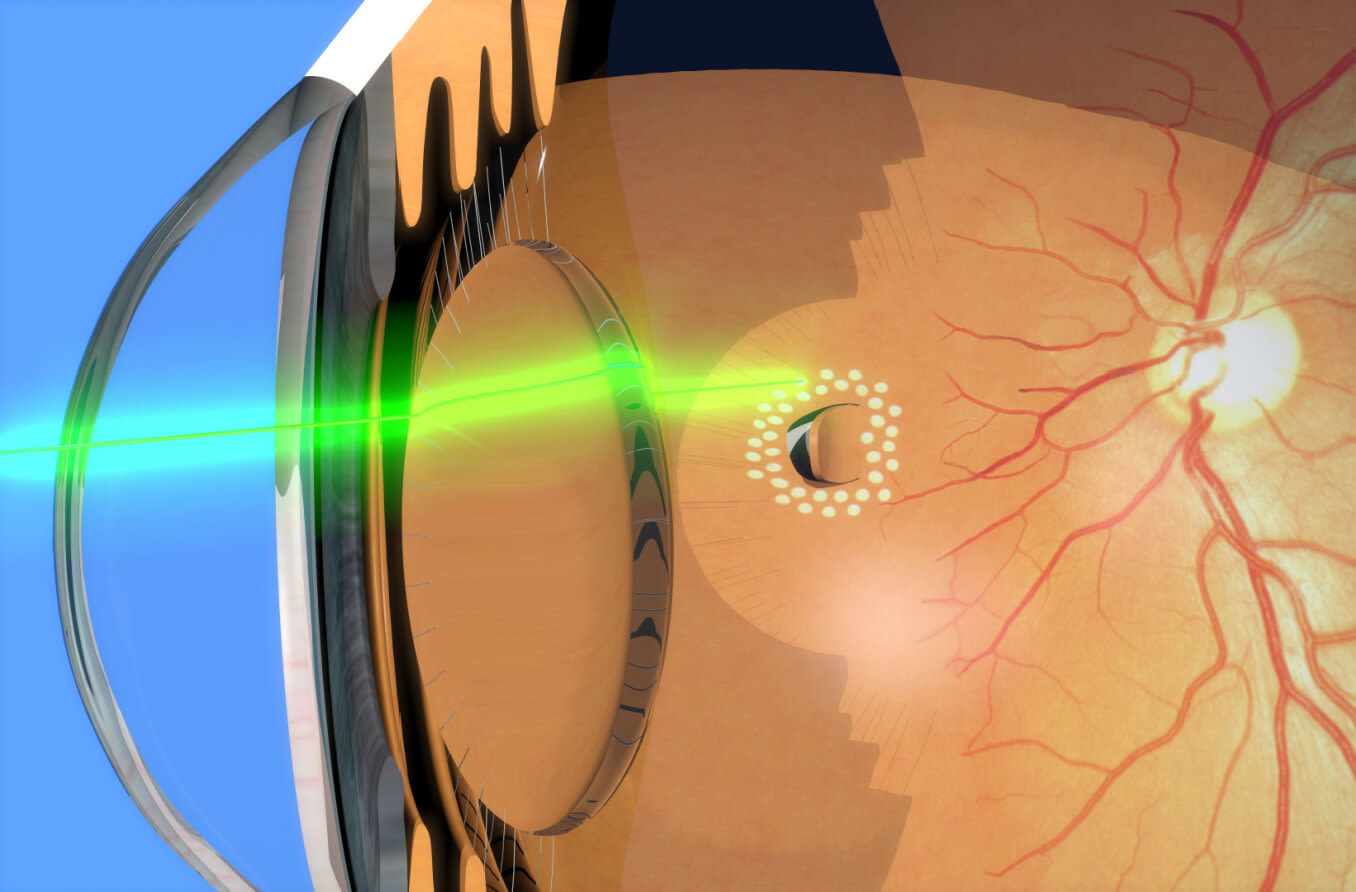 private retina laser therapy