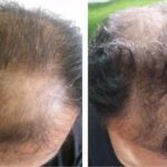 Using topical finasteride to treat male pattern baldness: advantages