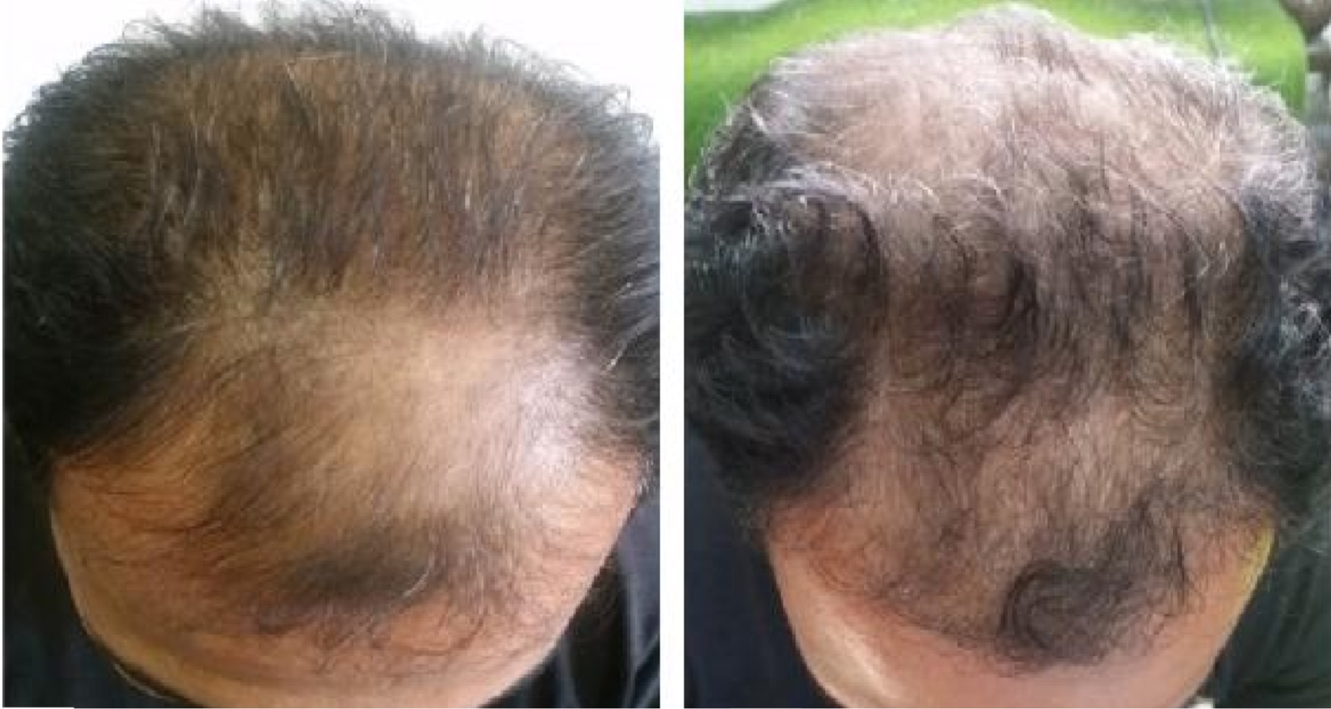 Using topical finasteride to treat male pattern baldness: advantages